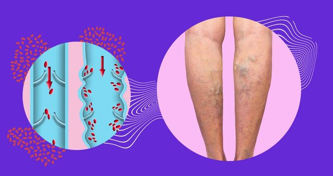 Varicose veins on a female senior legs. The structure of normal and varicose veins. Concept of dry skin, old senior people, varicose veins and deep vein thrombosis or DVT - 2D animation