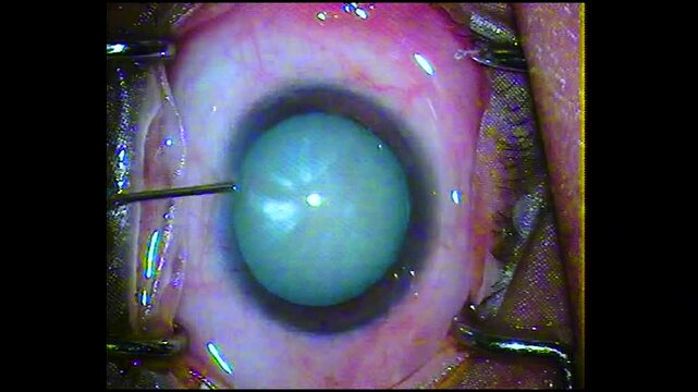 Phacoemulsification Cataract Surgery Stages Shown in Sequential Panel