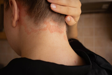 Fototapeta premium Psoriasis. Psoriasis plaques on a girl’s head. Itching and. rash on the body. Autoimmune diseases. Dermatological rashes 