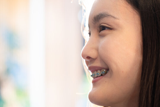 Smiling young asian woman with braces looking away, showing dental care