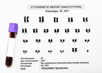 Klinefelter syndrome or KS with karyotyping report and blood sample, KS is a condition where the...