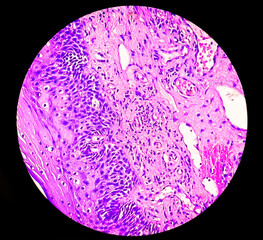 Photomicrograph of histological slide showing Neuroendocrine Cancer.