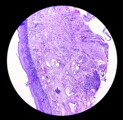 Photomicrograph of histological slide showing Neuroendocrine Cancer.