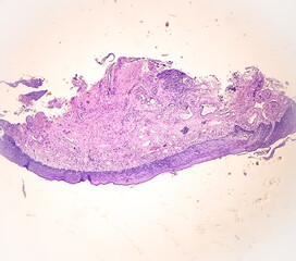 Photomicrograph of histological slide showing Neuroendocrine Cancer.