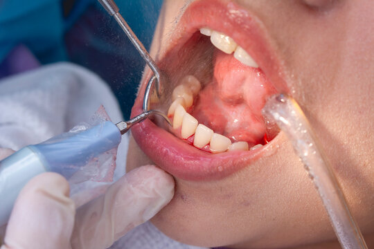 An oral prophylaxis procedure. A dental scaler removes plaque in between the lower incisors, with a dental mirror for visibility and a saliva ejector to keep the mouth dry during cleaning.