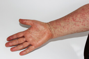 human skin covered with an allergic rash measles dermatitis insect bite hand with an allergic rash