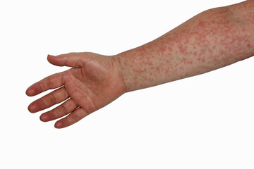 Human skin covered with rash, allergic rash, measles, dermatitis, hand with red