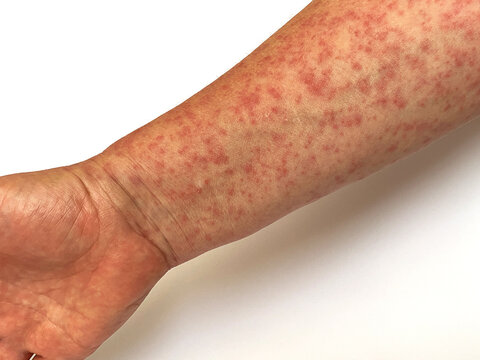 Human skin covered with rash, allergic rash, measles, dermatitis, insect bite, hand with red