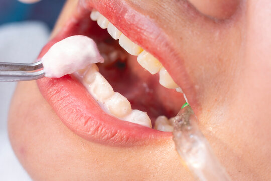 A dental professional using tweezers to apply a medicated paste or fluoride gel onto the patient&rsquo;s teeth. A saliva ejector is present