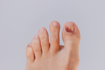 Subcutaneous hematoma. Bruise on the toe nail from tight shoes isolated on a light grey background
