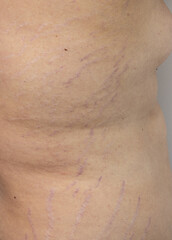 A woman's stomach has a purple scar