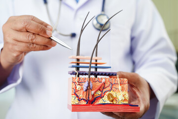 Hair transplant, Asian dermatologist doctor holding skin structure anatomy model for treatment in...
