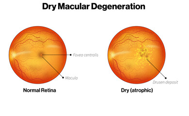 Dry Macular Degeneration vs Normal Retina Scientific Illustration, Comparison Visualization