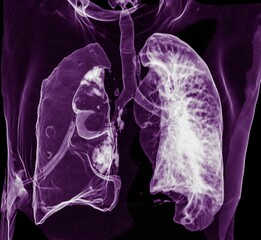 Coloured 3D computed tomography (CT) scan of the chest of a 60 year old male patient with shortness...