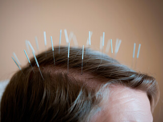 Naklejka premium A detailed isolated photo of scalp acupuncture, showcasing fine needles placed in hair. This image captures essence of traditional healing practices and promotes relaxation and wellness