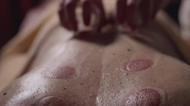 Close-up of Therapist Moving Vacuum Cups Over Client's Back During Cupping Therapy Treatment. Concept of Chinese Medicine, Healing, Detox, Wellness, Well-being, Blood, Releasing Muscle Tension