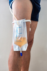 Man with a bag from the urethral catheter containing urine, attached to the leg