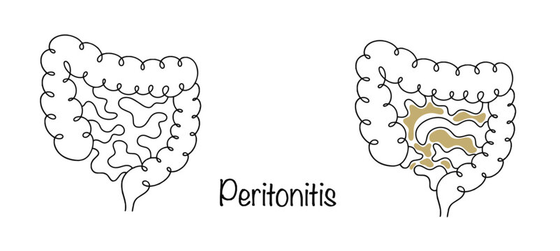 Peritonitis