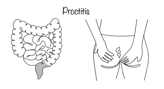 Proctitis