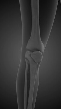 Chronic patella pain syndrome animation
