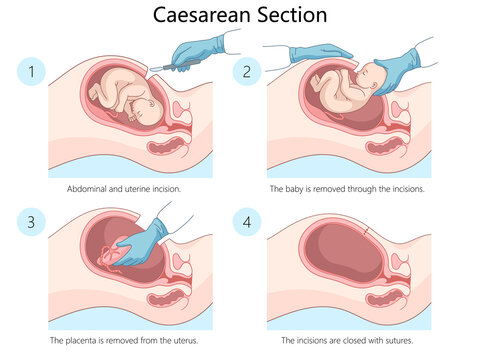 caesarean section procedure showing steps: incision, baby removal, placenta removal, suturing of incisions diagram hand drawn schematic raster illustration. Medical science educational illustration