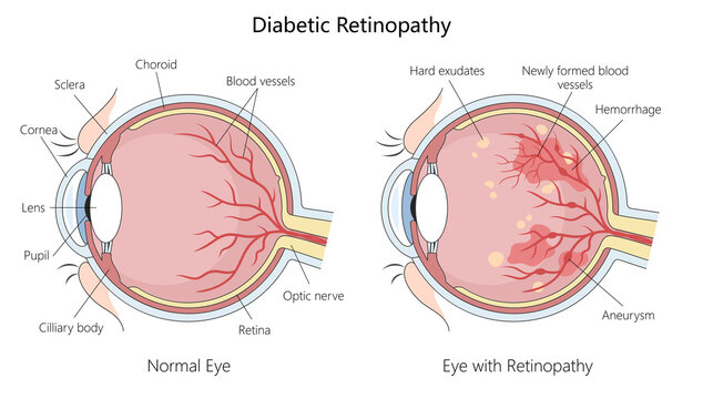 Normal eye and one affected by diabetic retinopathy, hemorrhages, aneurysms, and newly formed blood vessels hand-drawn schematic raster illustration. Medical science educational illustration
