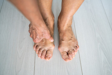 Foot deformity disease, growing bone on legs, preventing walking wearing shoes causing acute...