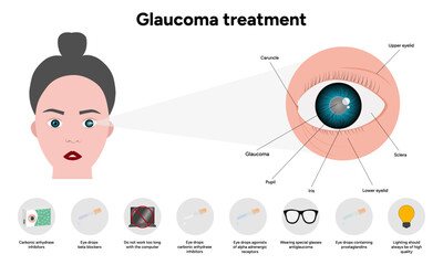 Glaucoma treatment medical information and anatomy ophthalmologist