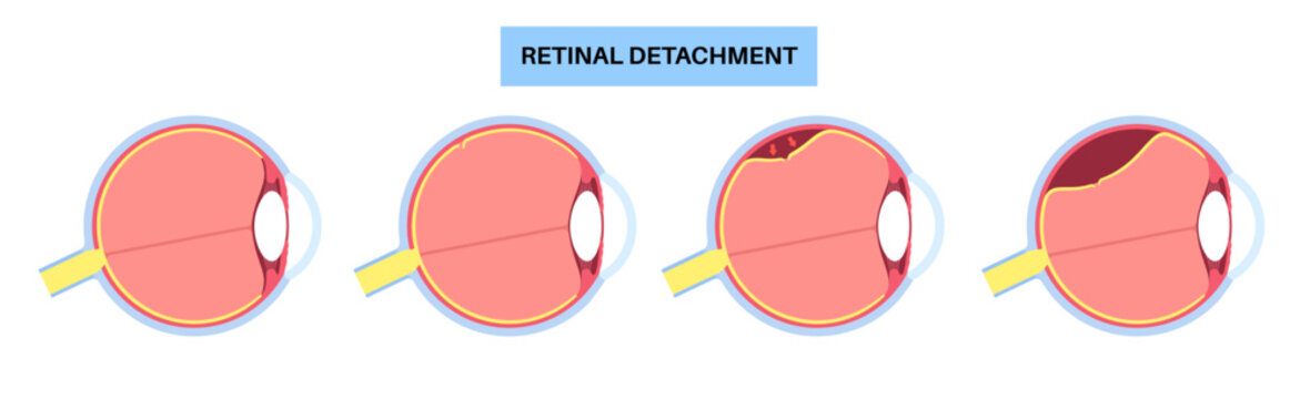 Retinal detachment eye disease