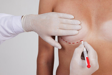 plastic surgeon drawing lines on woman's breast before mammoplasty surgery, breast augmentation