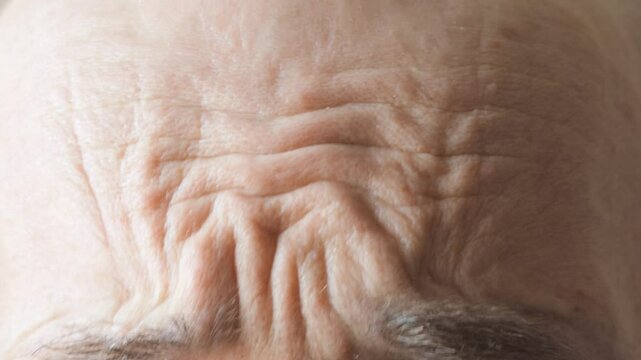 Deep wrinkles on the forehead of an adult man. Close-up