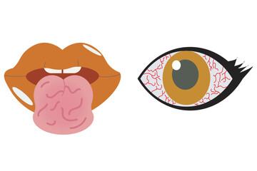Sjogren's syndrome is an autoimmune disorder that affects moisture-producing glands, causing dry eyes and mouth.rheumatoid arthritis,  lupus, and scleroderma.
