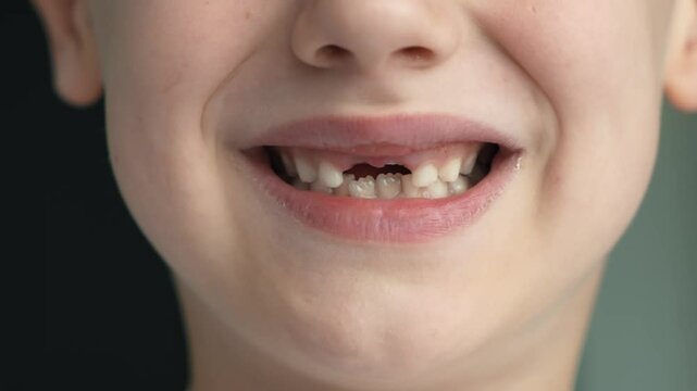 The child has lost two milk teeth. Replacement of permanent replacement teeth, toothless smile. The concept of children's dentistry. A toothless boy smiles at the camera. Close up