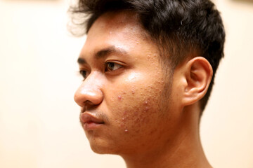 face of young Indonesian boy with acne on his cheek isolated on white background.