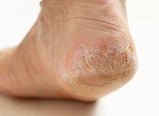 Cracked heel of a female foot with small bleedings and wounds. Dehydrated problematic dry skin of feet.