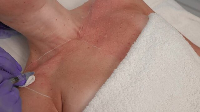 Treatment of decollete area skin by injection method, performed with sterile gloves and syringe, close up. Procedure of injection into female Upper Chest skin treatment with gloved hands
