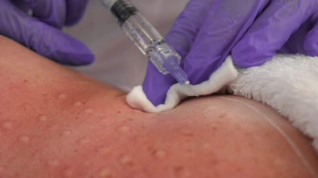 Treatment of decollete area skin by injection method, performed with sterile gloves and syringe, close up. Procedure of injection into female Upper Chest skin treatment with gloved hands