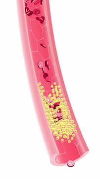 Anatomical vertical 3D animation of the interior of an artery clogged by fat. Red blood cells accumulate, forming a thrombus that prevents normal blood circulation.