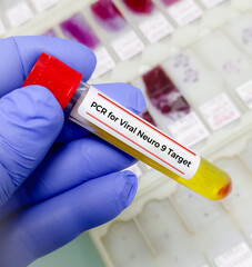 Pleural fluid sample for PCR test for viral neuro 9 target test. Meningitis or Encephalitis Panel