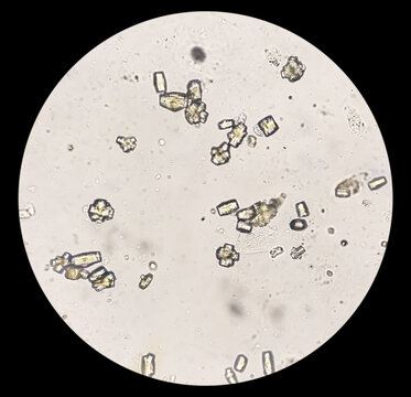 Microscopic image showing calcium oxalate monohydrate, uric acid crystals and triple phosphate crystals from urine sediment. UTI. kidney disease.