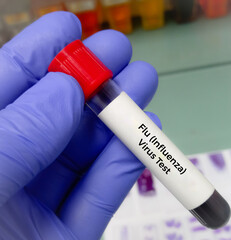 Blood Sample for H1N1Flu (swine flu) test. Influenza virus. Rapid Influenza Diagnostic Test (RIDT).