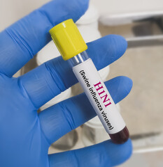 Blood Sample for H1N1Flu (swine flu) test. Influenza virus. Rapid Influenza Diagnostic Test (RIDT).