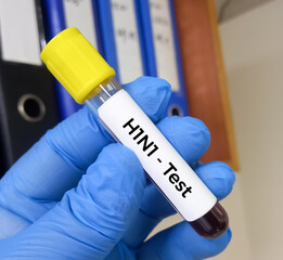 Blood Sample for H1N1Flu (swine flu) test. Influenza virus. Rapid Influenza Diagnostic Test (RIDT).