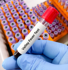 Valley fever disease test.Coccidioides precipitin, a blood test that looks for infections due to a...