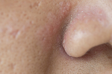 Scalp fungal infection that causes skin disease at the head, skin on the scalp to flake,Dandruff in the hair, Flaky scalp, Seborrhea. 