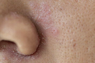Scalp fungal infection that causes skin disease at the head, skin on the scalp to flake,Dandruff in...