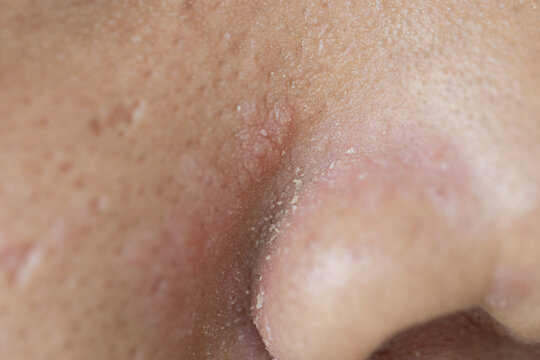 Scalp fungal infection that causes skin disease at the head, skin on the scalp to flake,Dandruff in the hair, Flaky scalp, Seborrhea. 