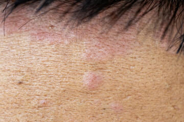Naklejka premium Scalp fungal infection that causes skin disease at the head, skin on the scalp to flake,Dandruff in the hair, Flaky scalp, Seborrhea. 