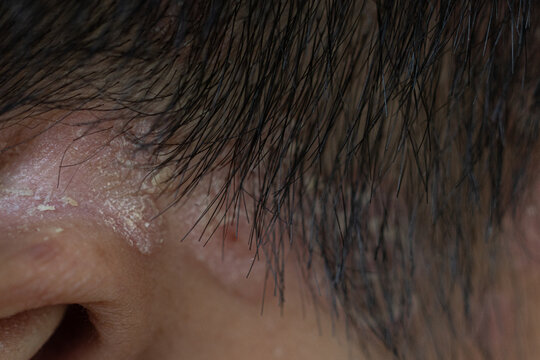 Scalp fungal infection that causes skin disease at the head, skin on the scalp to flake,Dandruff in the hair, Flaky scalp, Seborrhea. 