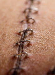 Staples surgical incision healing scar transplant operation closeup